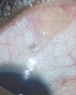 NEOflorax padėjo atsikratyti kirmino akyje